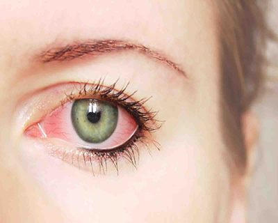What is Pink Eye?